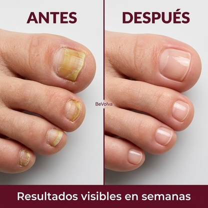 BeVolva™ - Solución Reparadora para Uñas